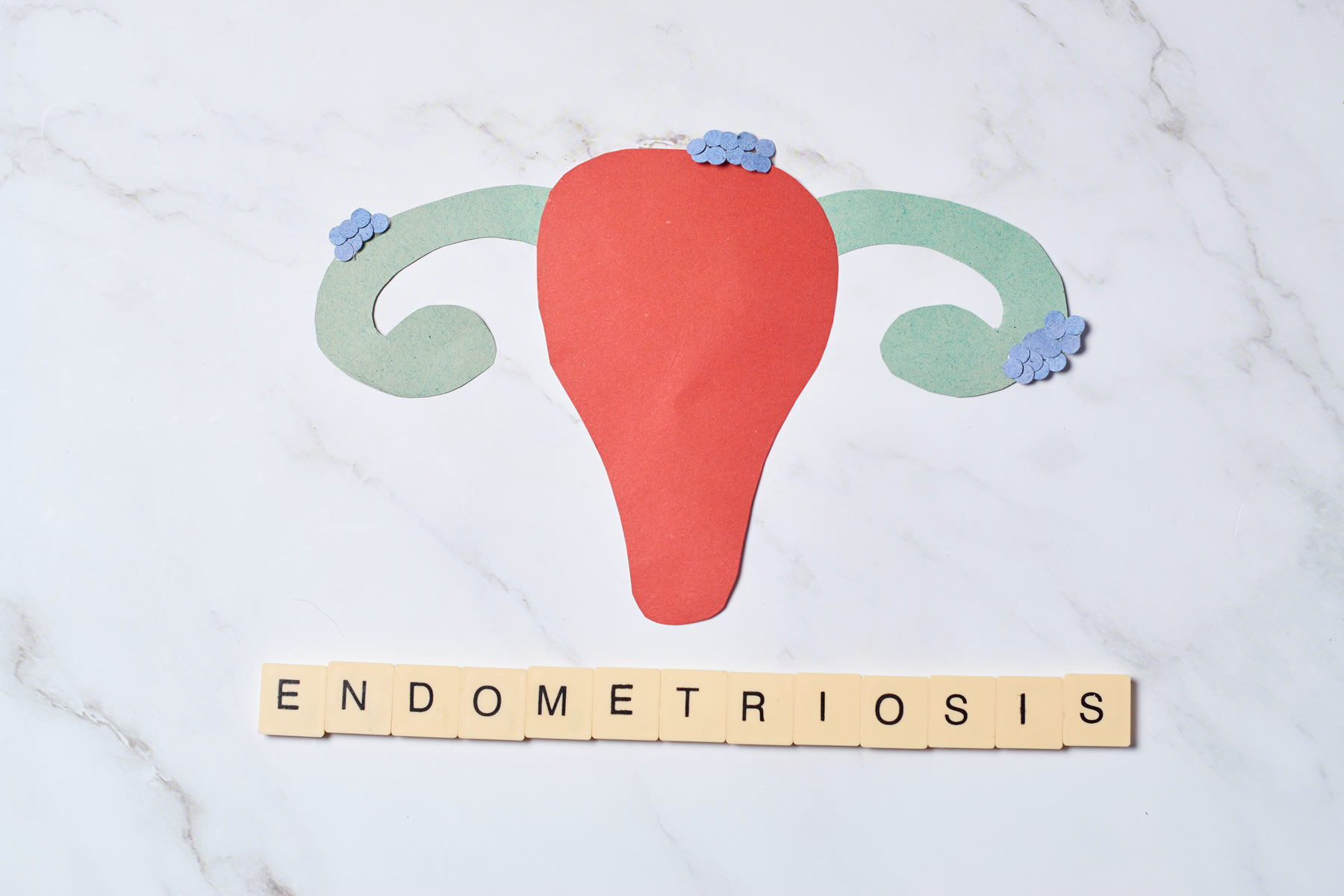 Endometriom – uzrokovan je endometriozom