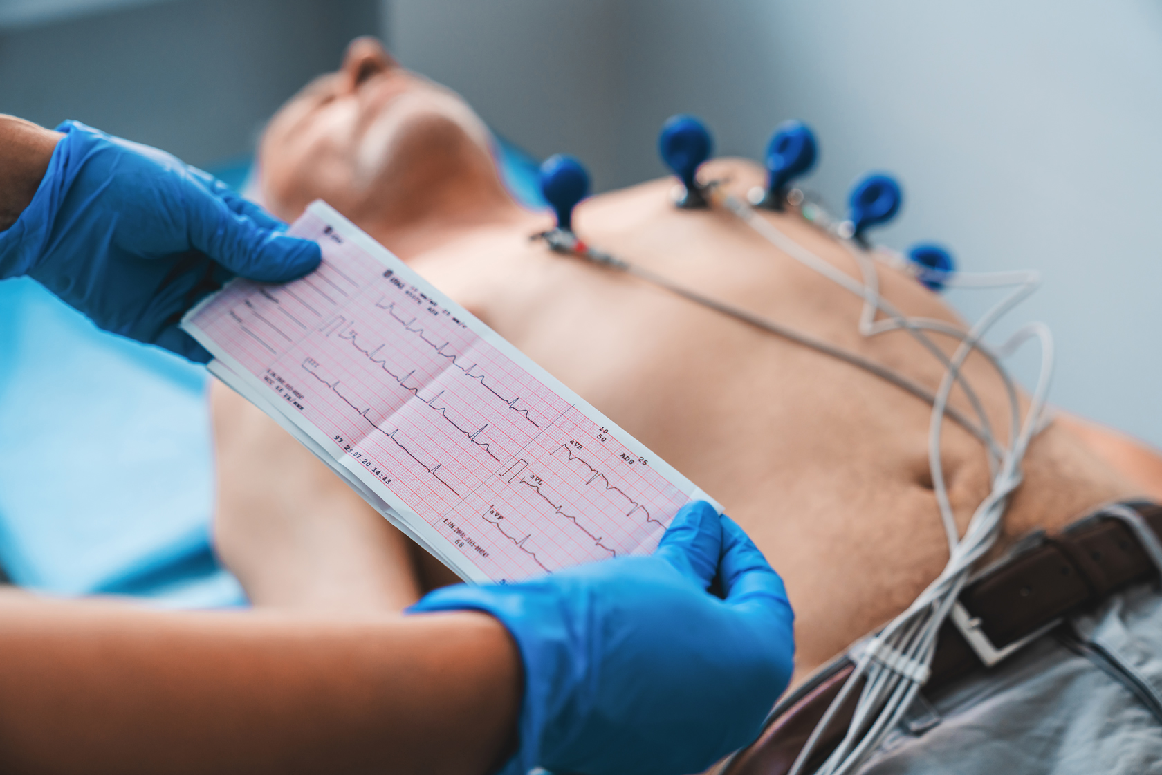 Electrocardiogram ECG